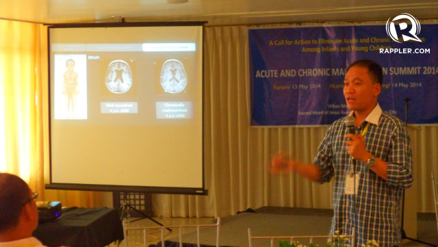ADVOCATE. Dr Martin Parreño explains the difference between the brain structures of healthy children (L) and malnourished children (R). The latter is less developed. Photo by Fritzie Rodriguez/Rappler.com